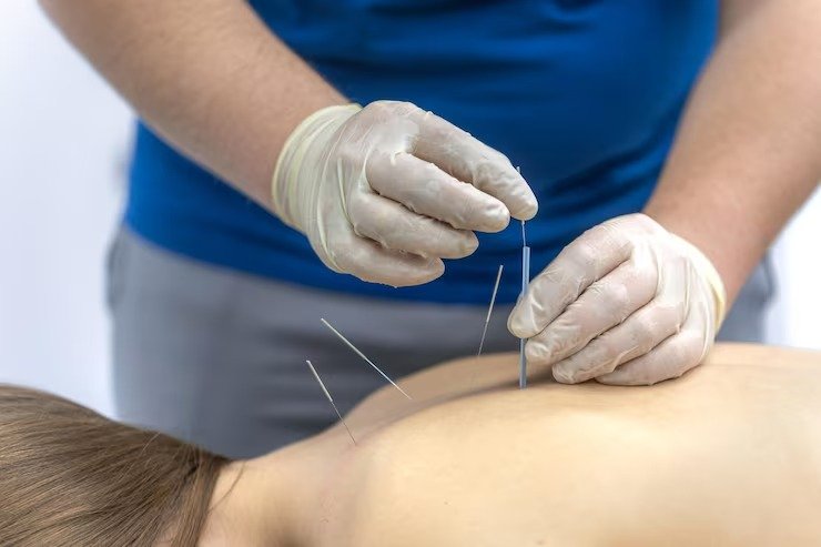 Acupuncture Wellness Therapy